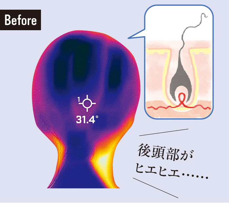 【Before】頭皮が冷えると白髪・薄毛に